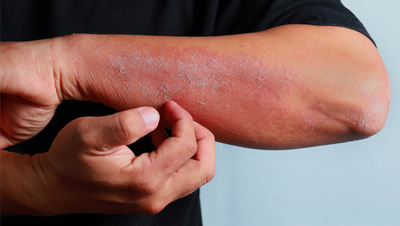 eczéma